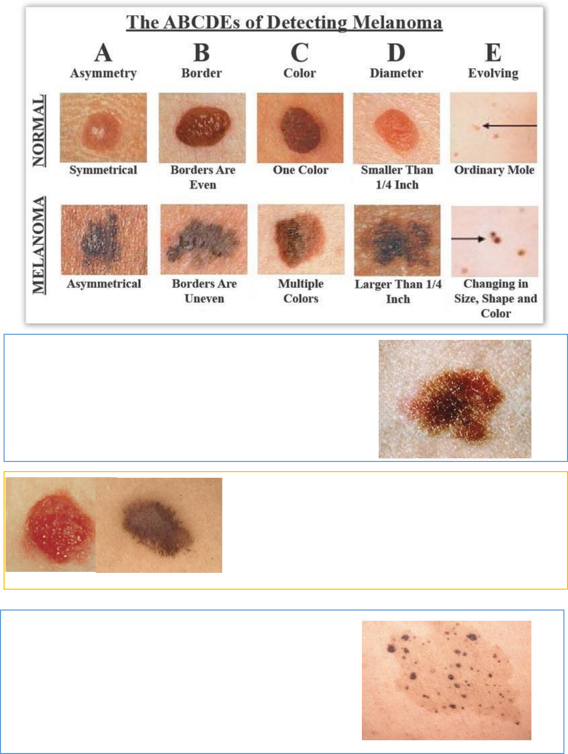 Grátis: LESÕES MELANOCÍTICAS (EPIDÉRMICAS, DÉRMICAS E NEVOS) BENIGNAS -  Material Claro e Objetivo em PDF para Estudo Rápido, image size:1116x1482