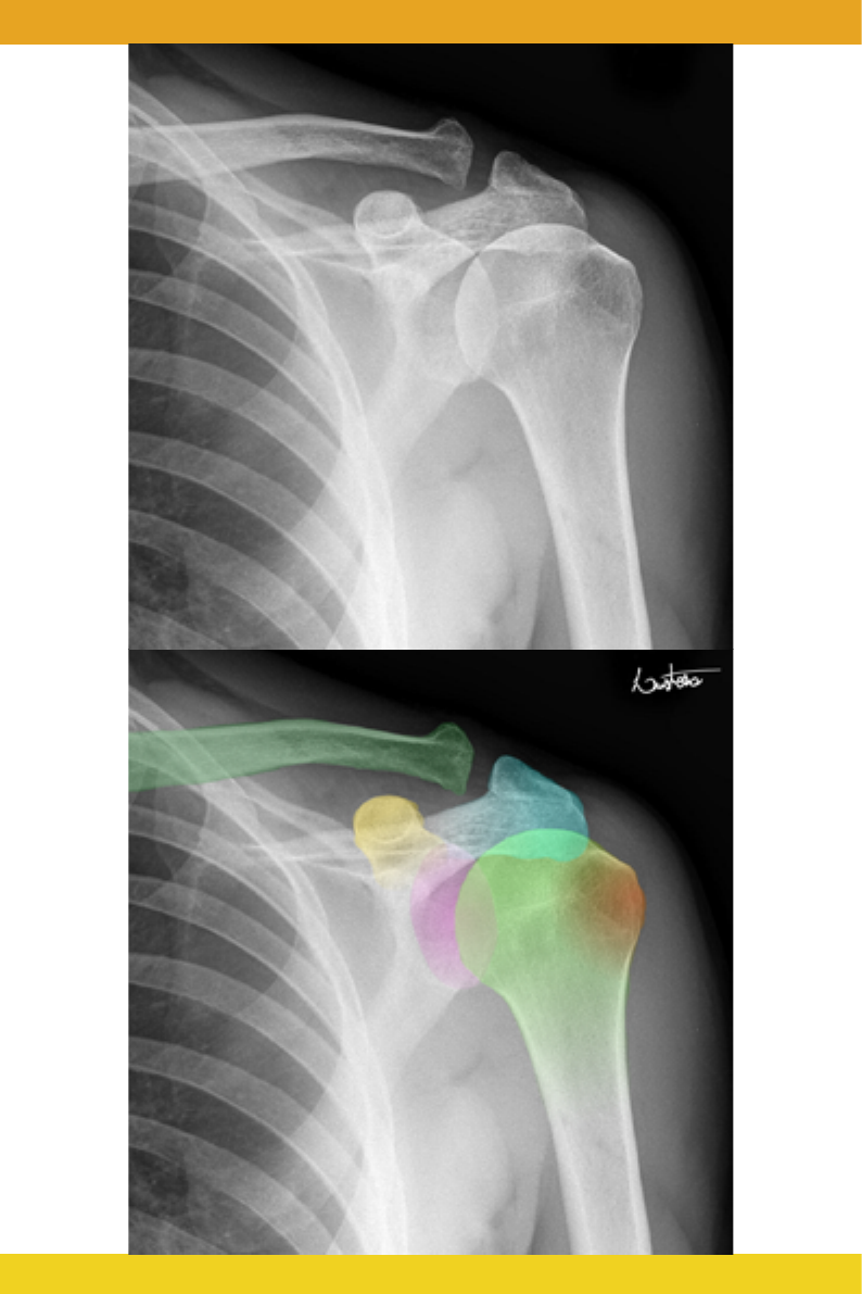 rEABILITAÇÃO FRATURAS DE COTOVELO OLÉCRANO | Questões de fisioterapia  comentadas, image size:794x1191