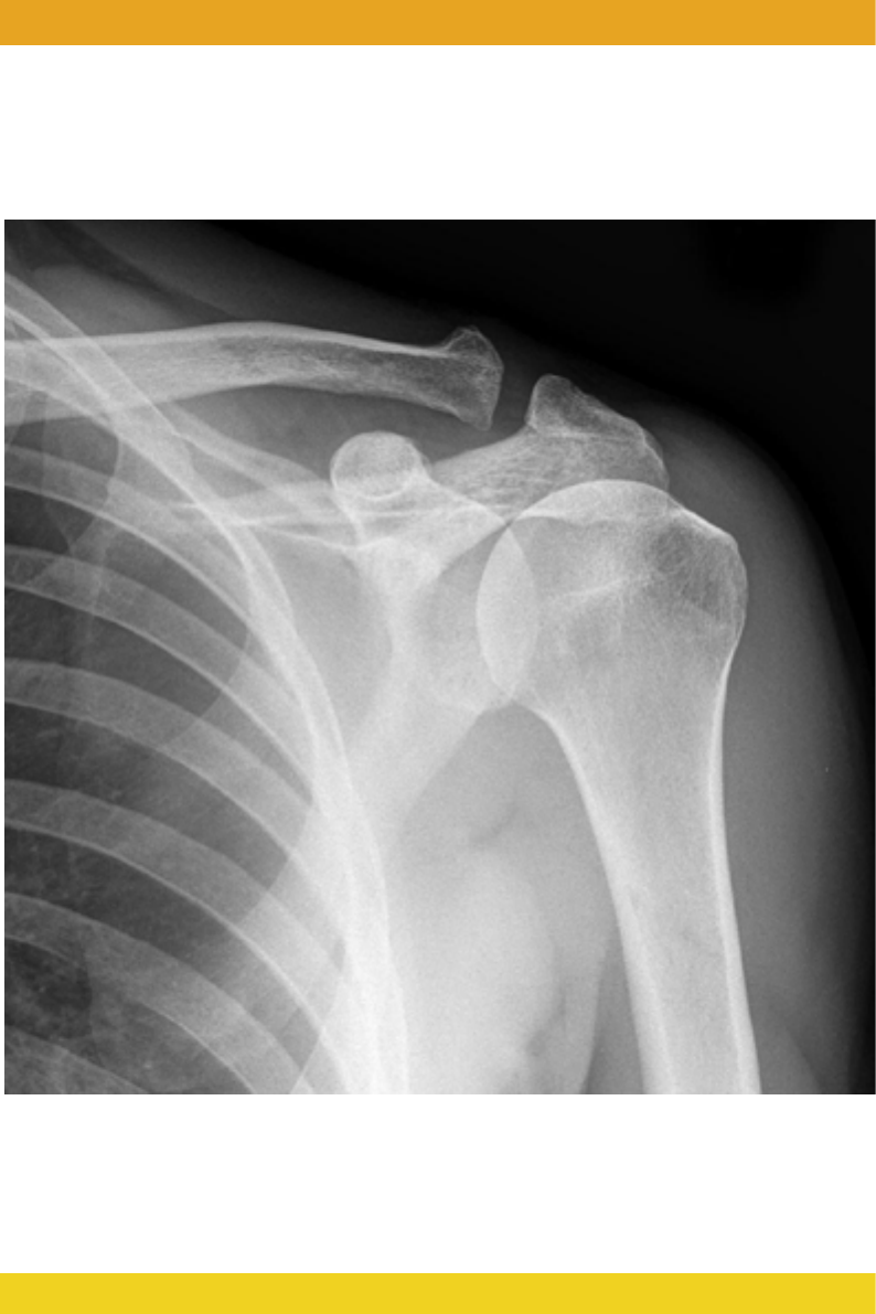 Radiografia Pelve Quadril Paciente Com Dor Quadril Mostrando Necrose  Avascular — Foto © Richmanphoto #664386482, image size:794x1191