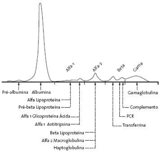 eletroforese mieloma múltiplo