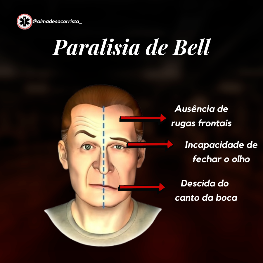 Paralisia de Bell - Emergências Clínicas