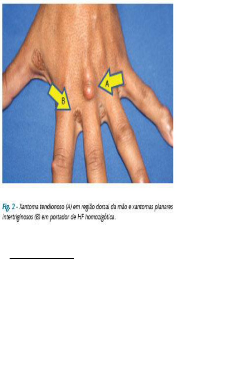 Grátis: Hipercolesterolemia- escrito - Material Claro e Objetivo em PDF  para Estudo Rápido, image size:855x1267