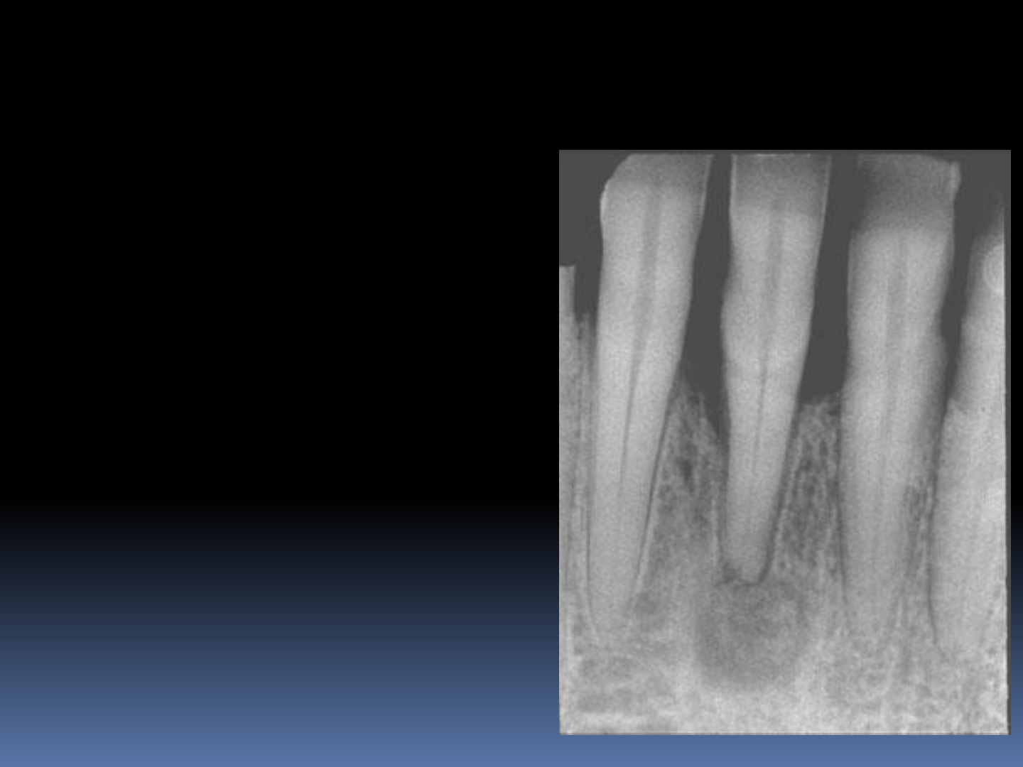 Grátis: AULA 07 Osteomielite (PARTE II) e lesões potencialmente malignas -  Material Claro e Objetivo em PDF para Estudo Rápido, image size:1440x1080
