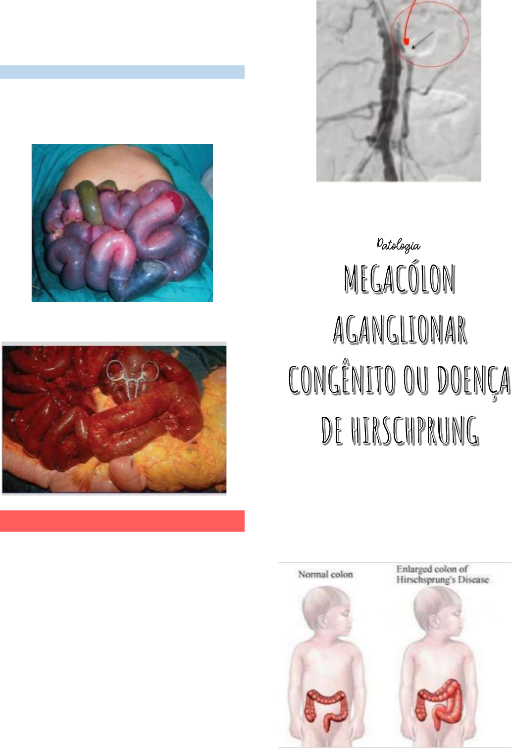 Grátis: 5- Abdome Agudo Obstrutivo - Material Claro e Objetivo em PDF para  Estudo Rápido, image size:1034x1511