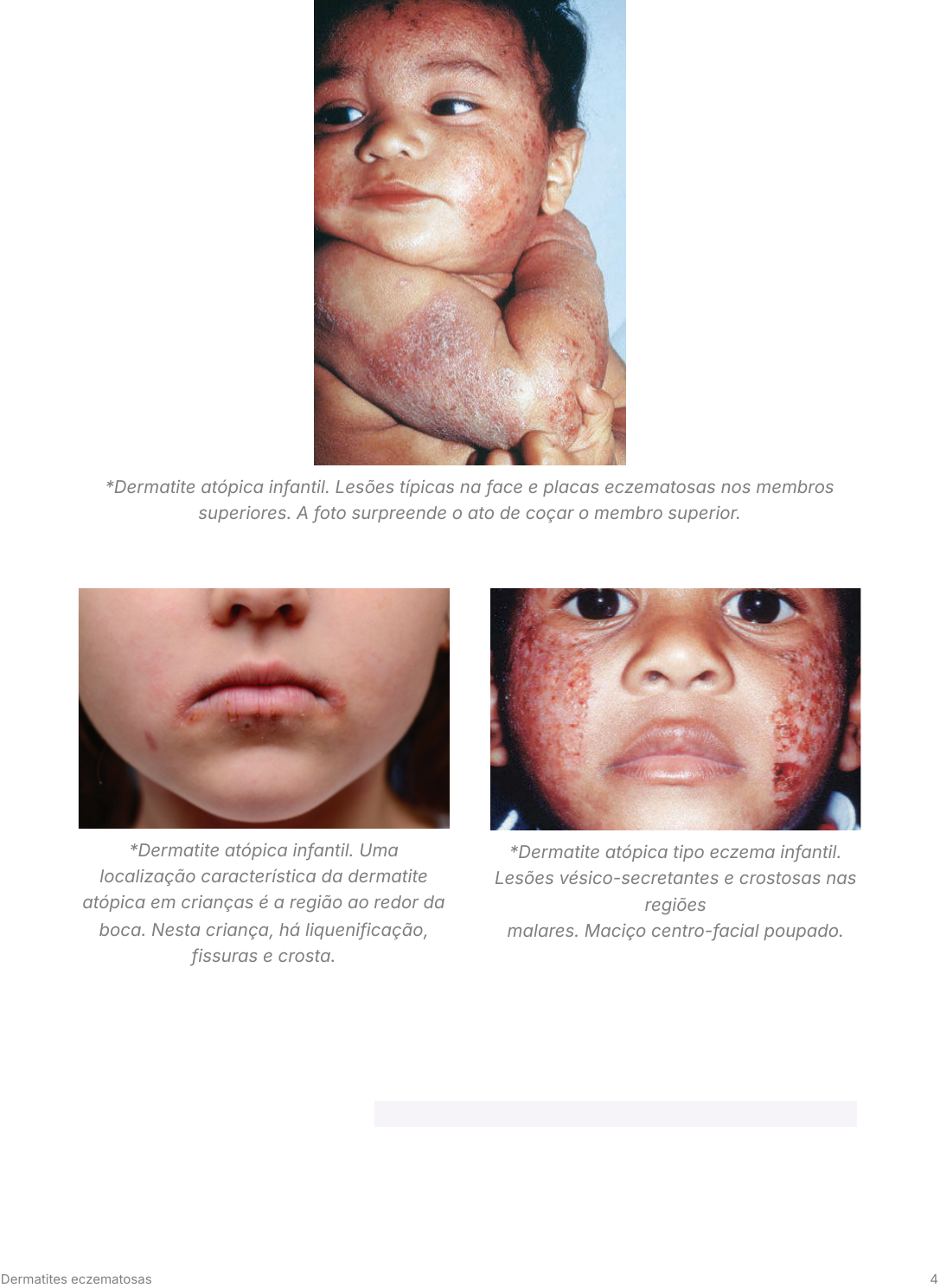 MULETA CIENTÍFICA - DAS ARTES AO DIREITO. PERFEITO!: Eczema: Causas,  Sintomas E Tratamentos, image size:1087x1489