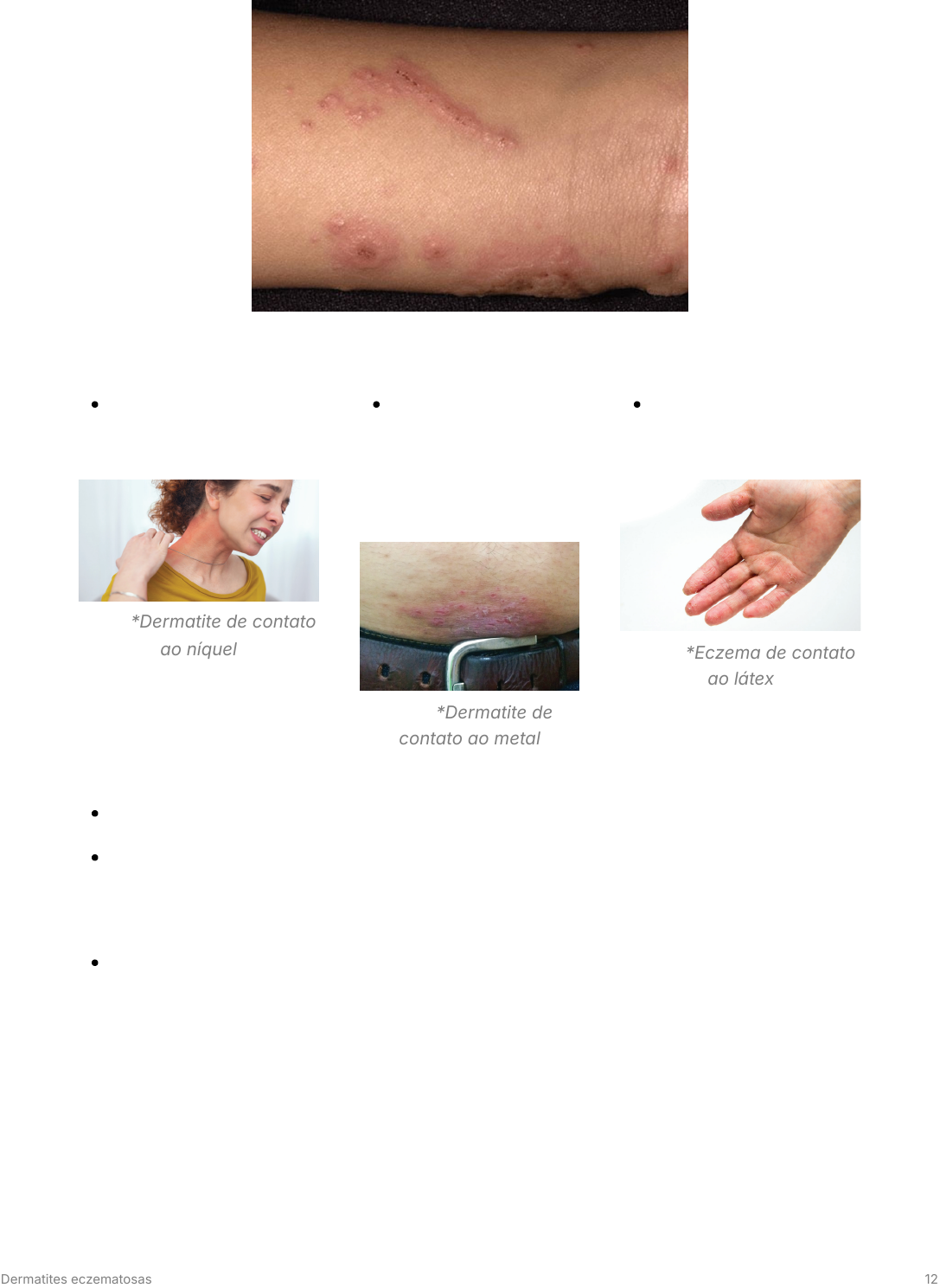 Grátis: Dermatites eczematosas - Material Claro e Objetivo em PDF para  Estudo Rápido, image size:1087x1488