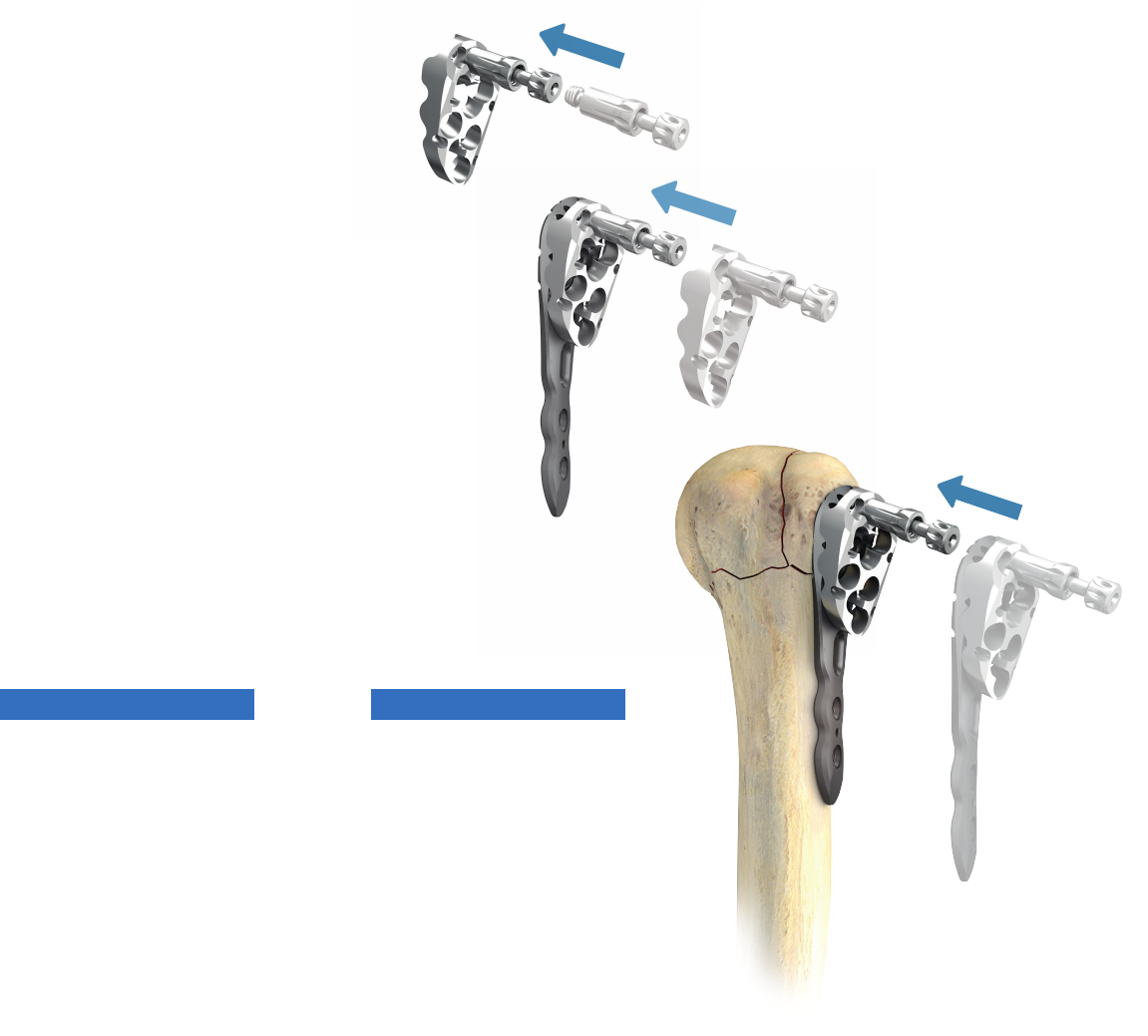 MRI with state-of-the-art metal artifact reduction after total hip  arthroplasty: periprosthetic findings in asymptomatic and symptomatic  patients | European Radiology, image size:1151x1039