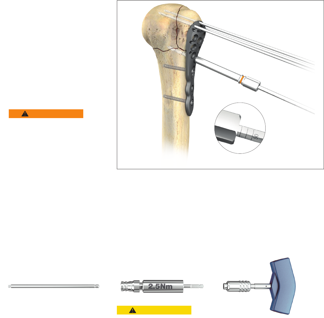 Haste Femoral Expert - TOOLMED, image size:1109x1088