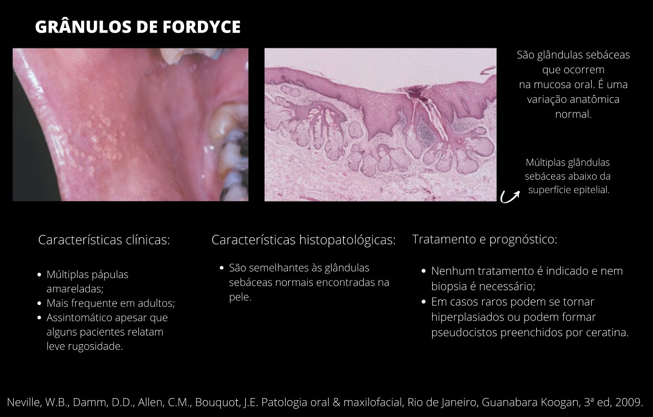 grânulos de fordyce patologia oral