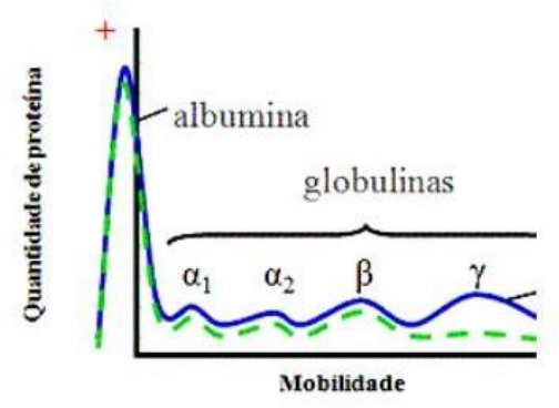 eletroforese mieloma múltiplo