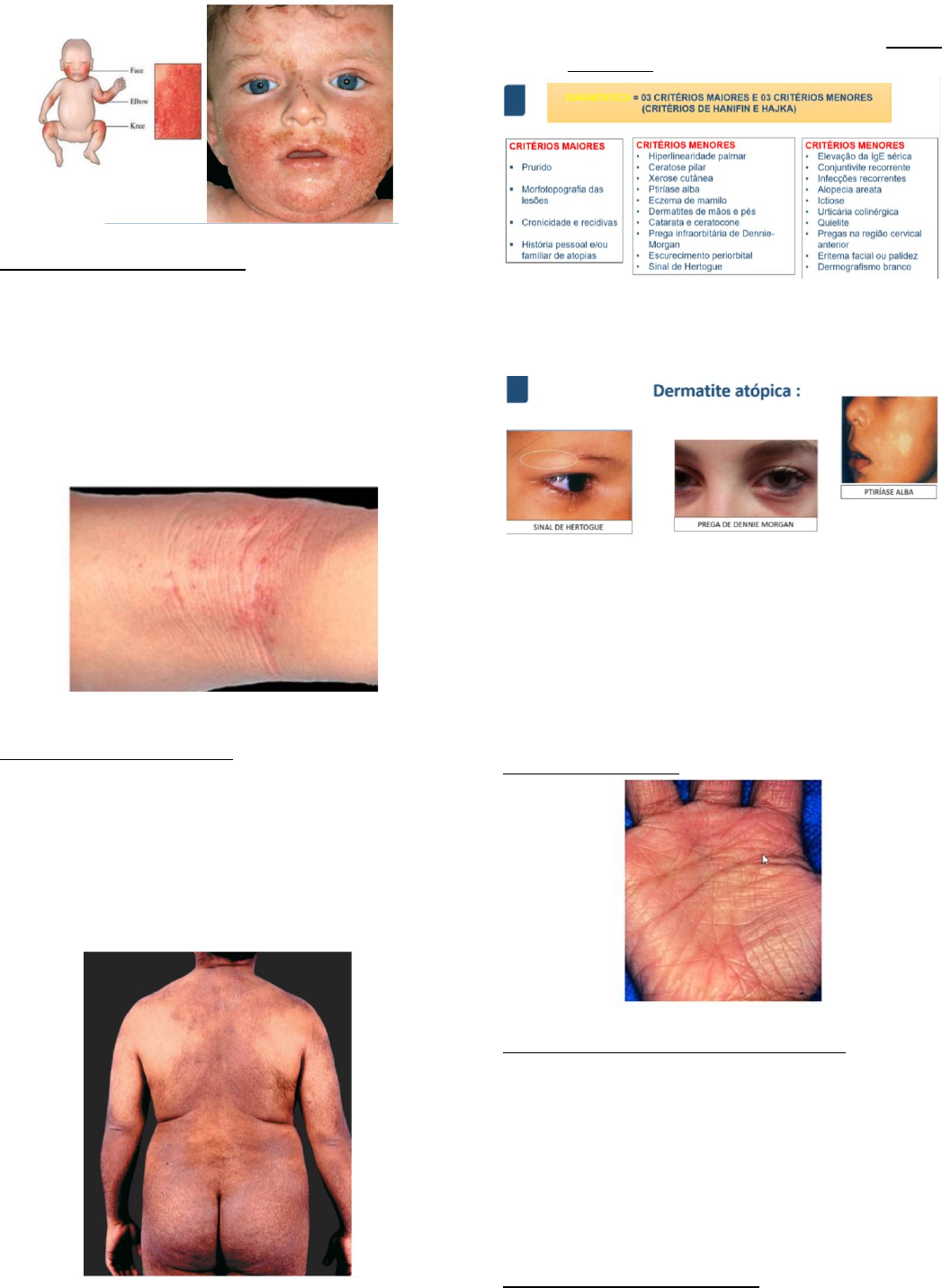 Sofia Candeias de Matos - Acupuntura - 🌱Trata-se de uma lesão cutânea  caracterizada por uma placa de cor vermelho vivo, pruriginosa. ⠀ ⠀ 🌱Nas  crianças o eczema é mais comum nos braços,, image size:1047x1432