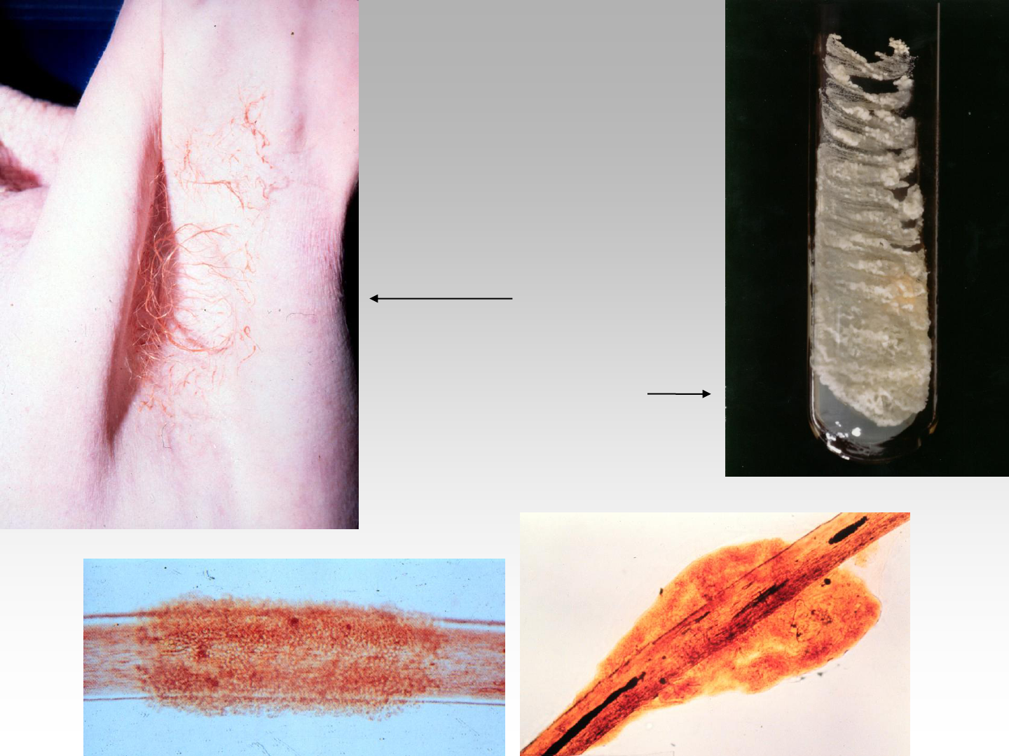 Micose na virilha (tinea cruris): sintomas e tratamento