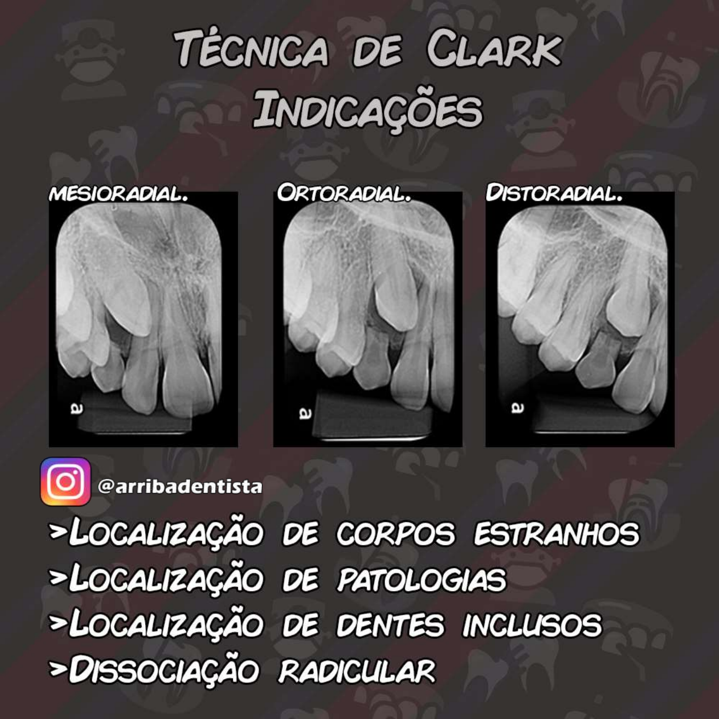 técnica de clark dissociação radiográfica resumo indicações