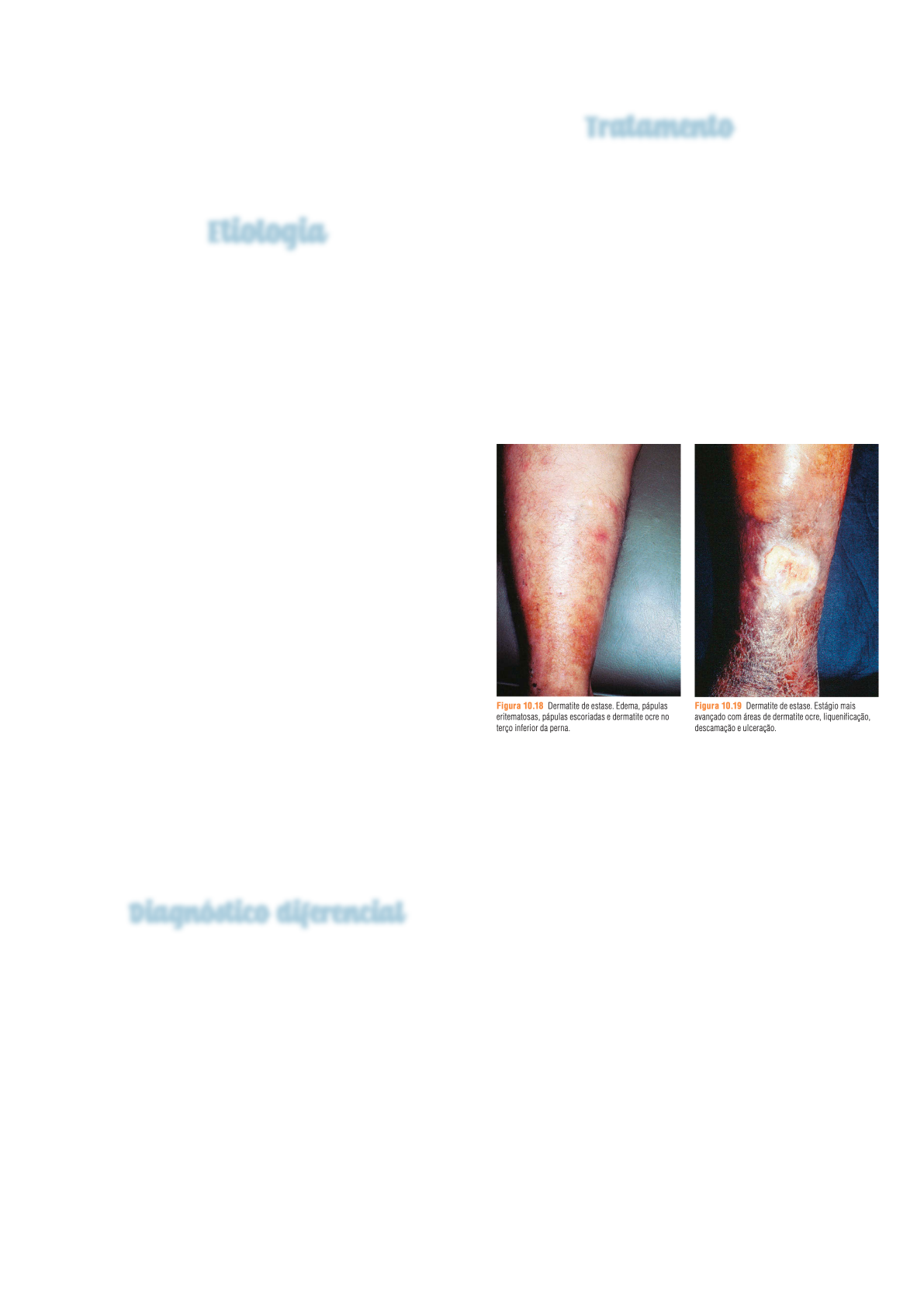 Clinica - A dermatite atópica, também conhecida como eczema atópico,  apresenta uma variedade de sintomas que podem variar em intensidade e  localização. Reconhecer esses sinais é crucial para um diagnóstico precoce e, image size:1191x1684