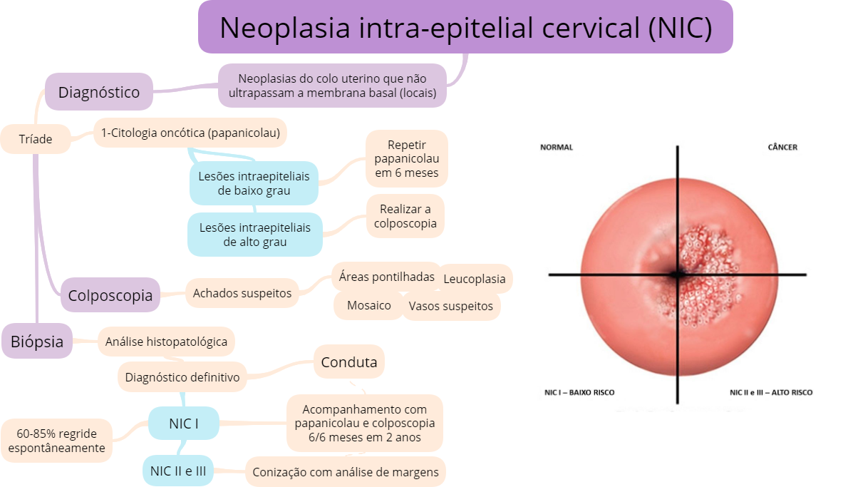 Neoplasias intraepiteliais cervicais (NIC) - Ginecologia