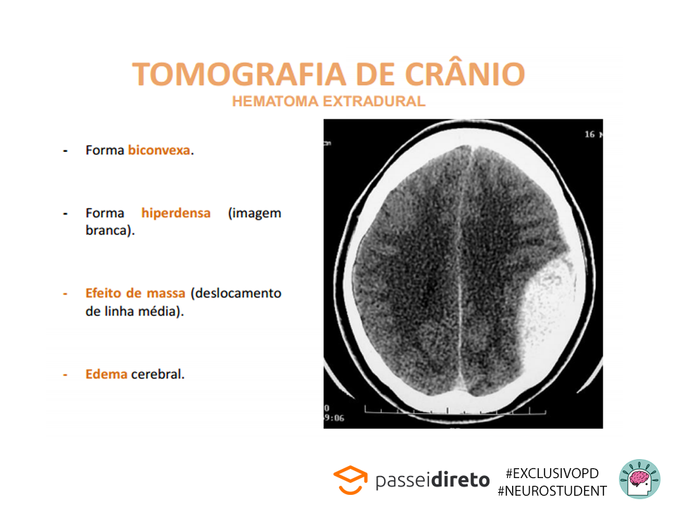 Tomografia De Cr Nio Hematoma Extradural Neuroanatomia Funcional