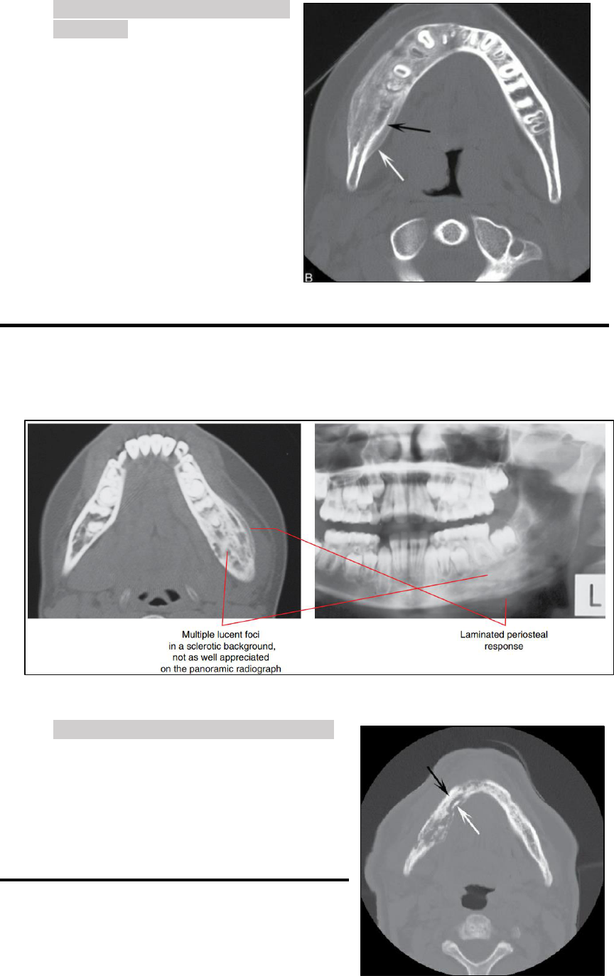 Importância dos aspectos imaginológicos no plano de tratamento da displasia  óssea florida: Relato de caso, image size:864x1372