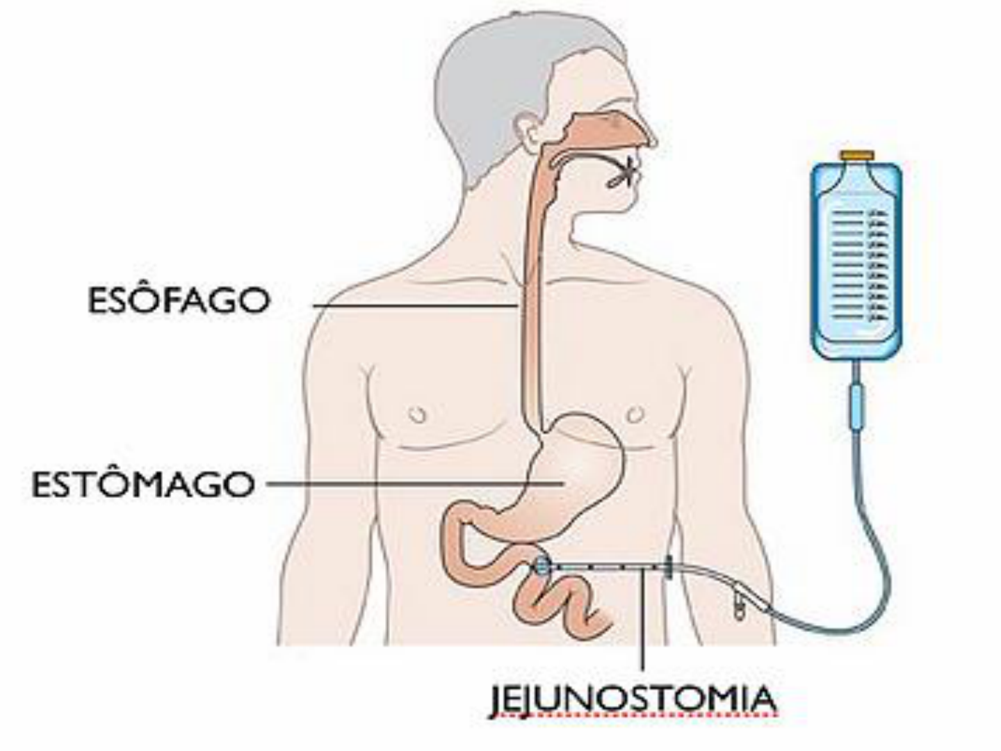Cuidados De Enfermagem Na Jejunostomia - RETOEDU