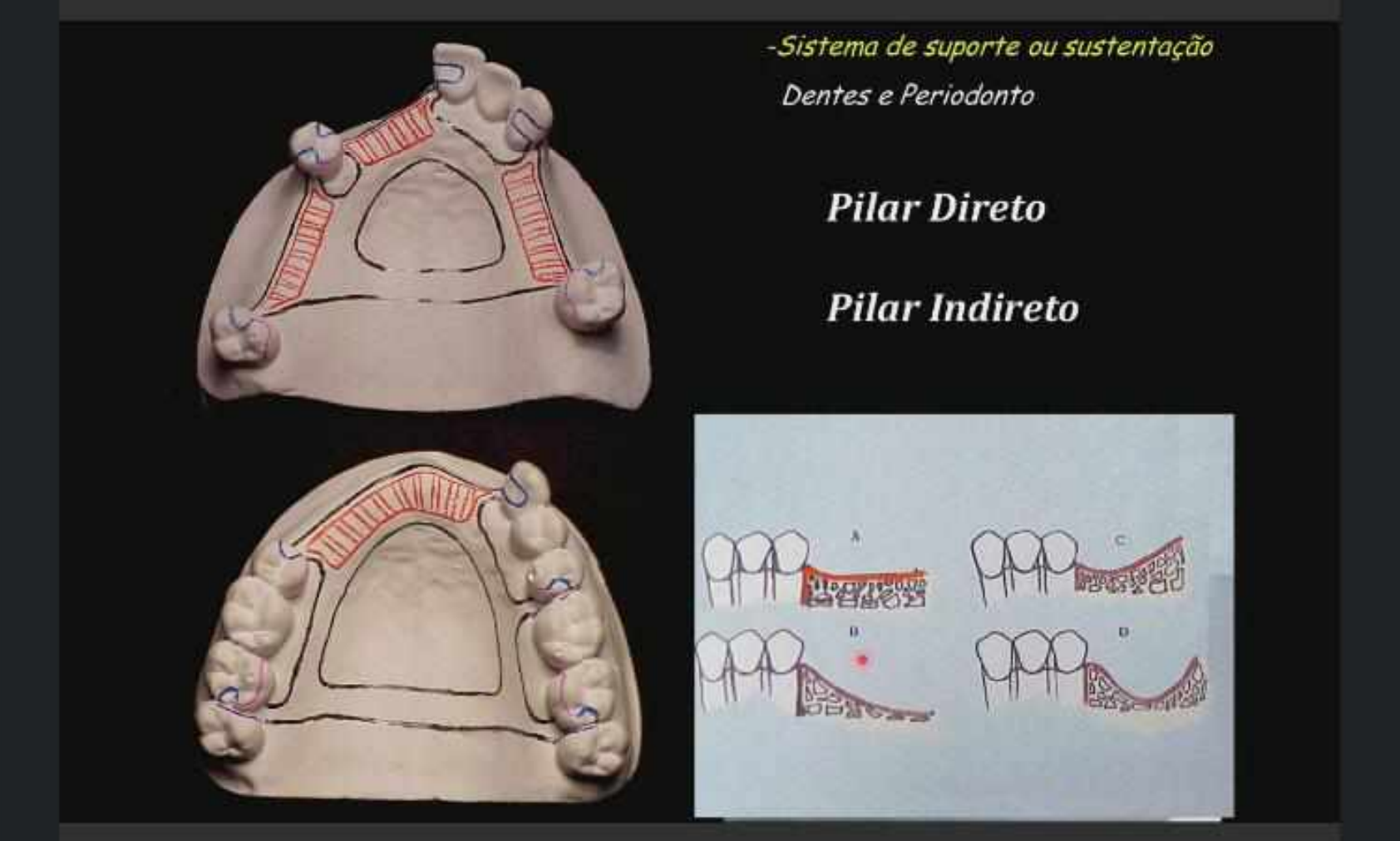 PPR - Protese Parcial Removivel