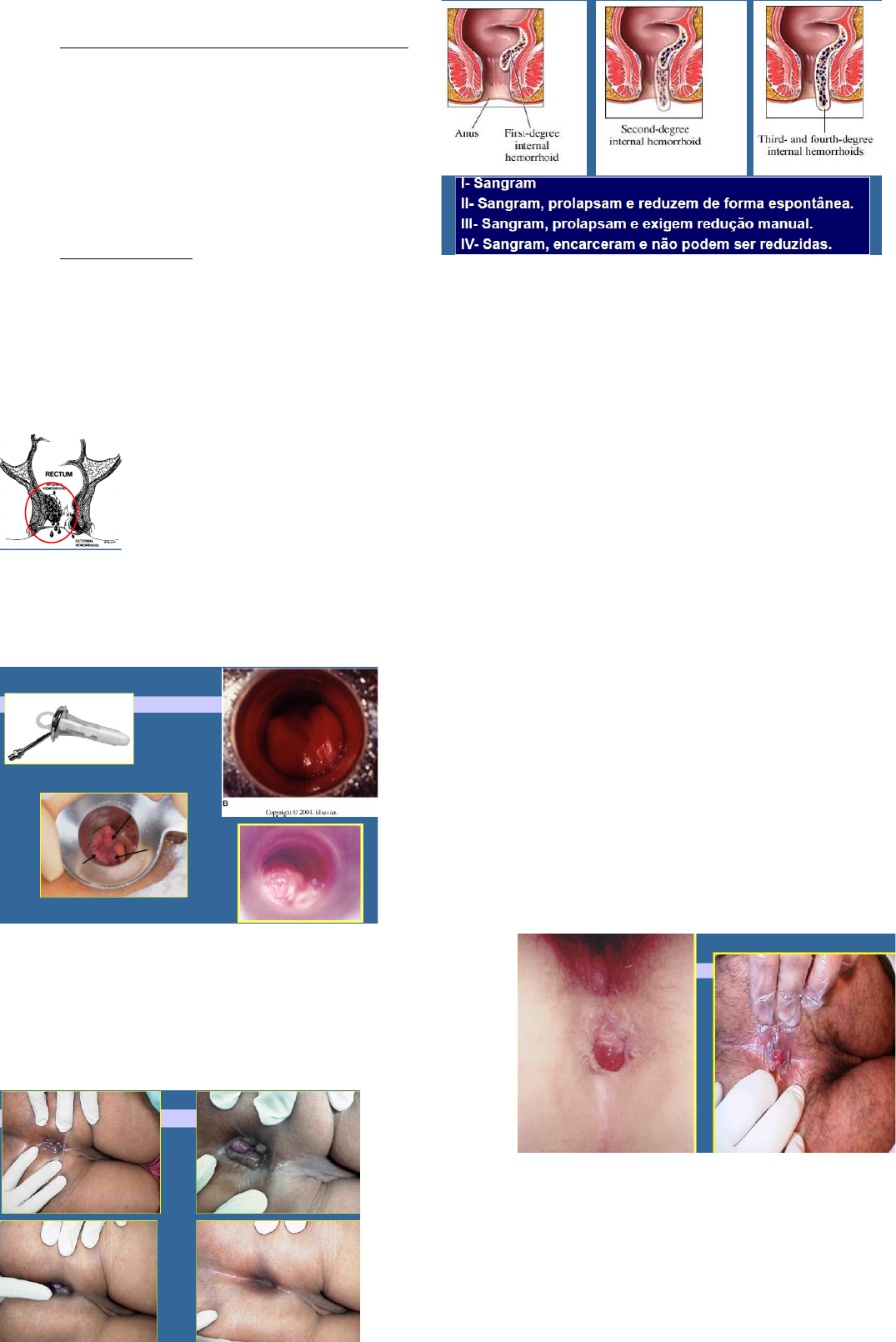 13-P2 - 5 Afecções cirúrgicas de reto e ânus - Cirurgia