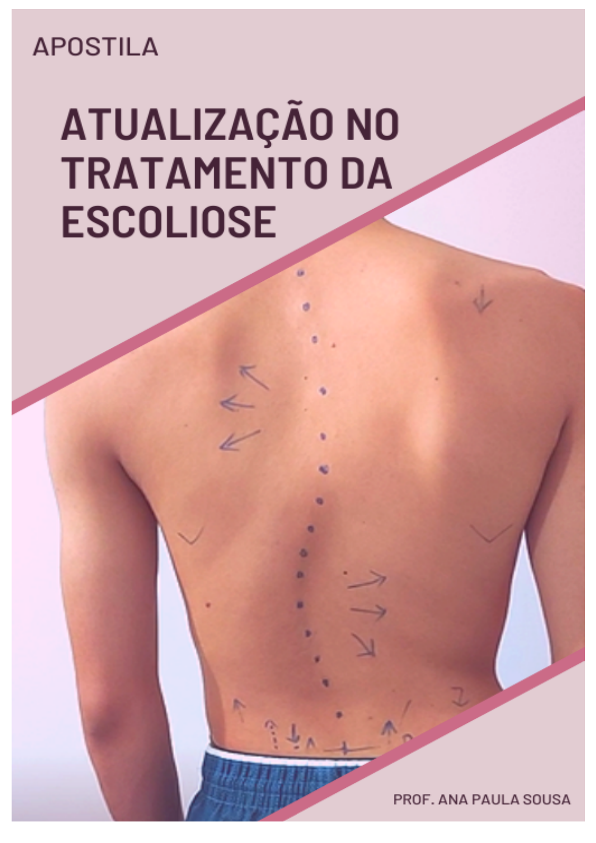 Educação Física 2016: (1_EDFIS_LIC_NA_Jessel_Martins) PROBLEMAS DE COLUNA  NA ADOLESCÊNCIA, image size:1191x1684