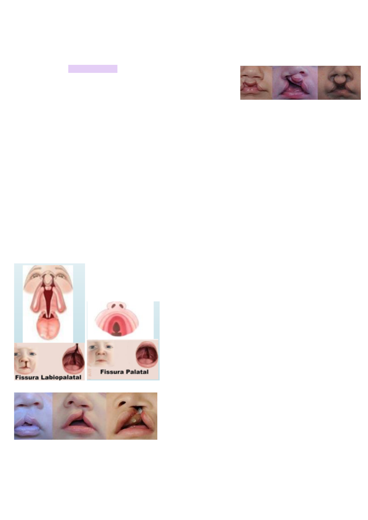 Fissuras Lábio Palatinas - Cirurgia Geral I