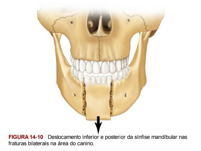 CLASSIFICACAO DE FRATURAS MANDIBULARES Cirurgia Oral e Maxilofacial