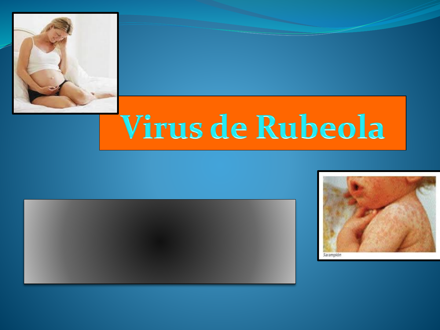 estructura del virus de la rubeola