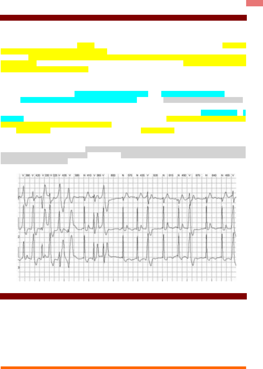 taquicardia ventricular polimórfica