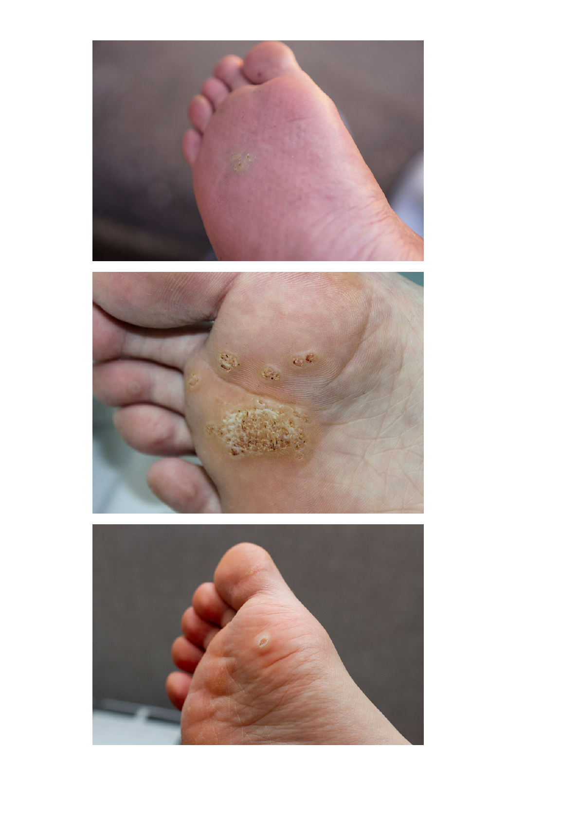 Nitrogênio Líquido Remove Verrugas - Ferramentas Eficientes de Crioterapia, image size:1190x1684