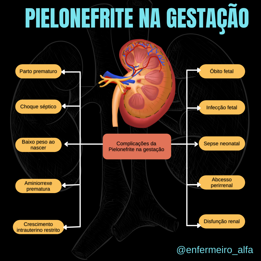 Pielonefrite Na Gravidez CT Of The Xanthogranulomatous Pyelonephritis