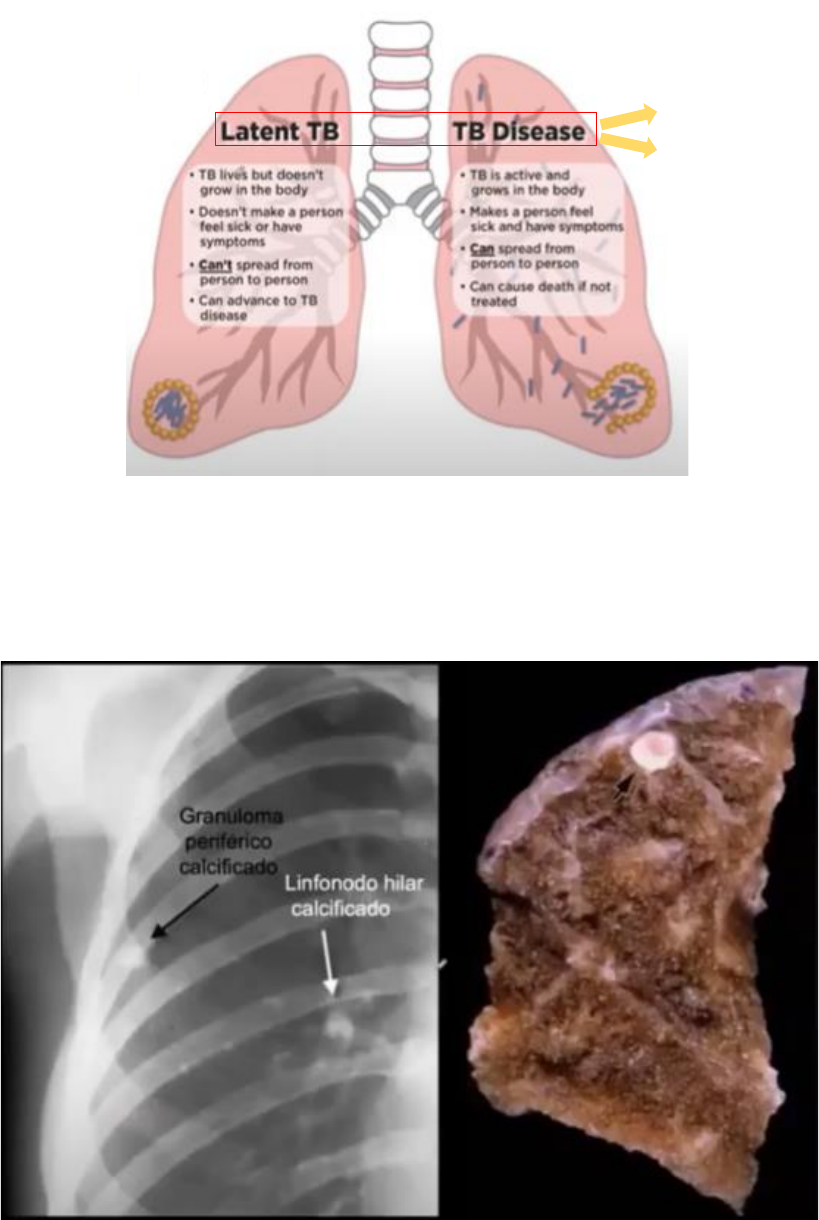Grátis: TUBERCULOSE - Material Claro e Objetivo em PDF para Estudo Rápido
