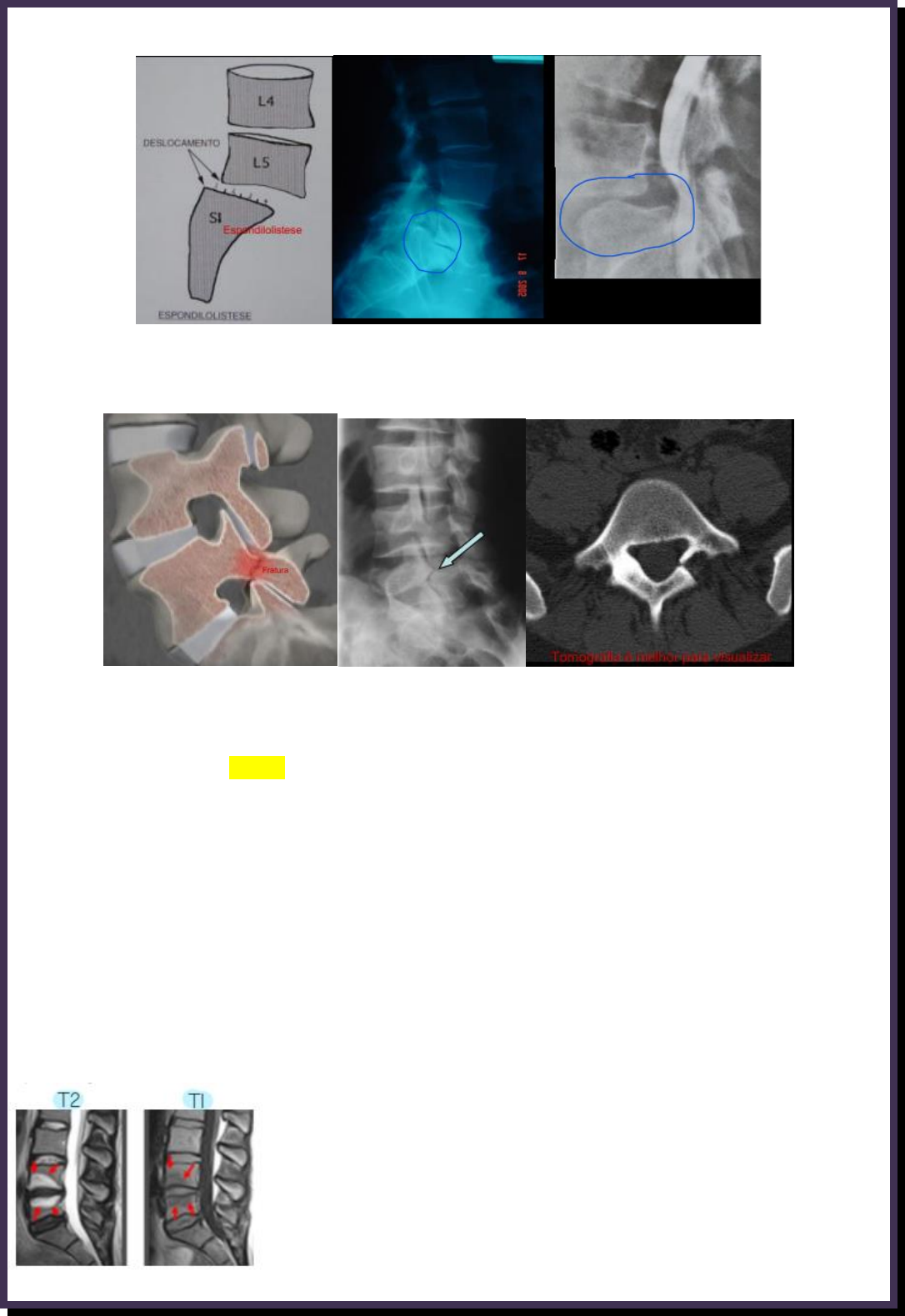 Ressonância magnética (T1) evidencia hérnia discal extrusa L4-L5