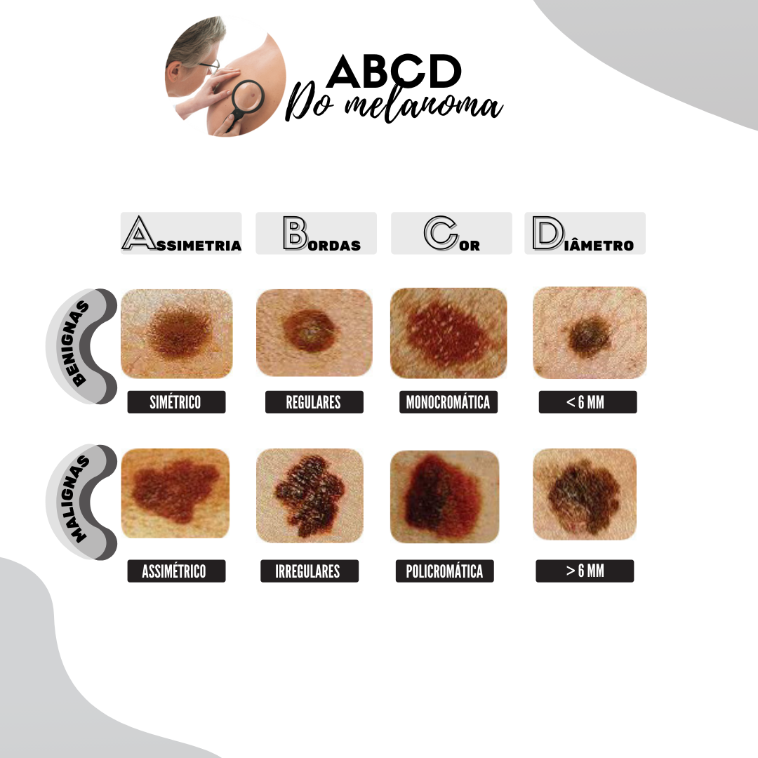 ABCD do melanoma Dermatologia