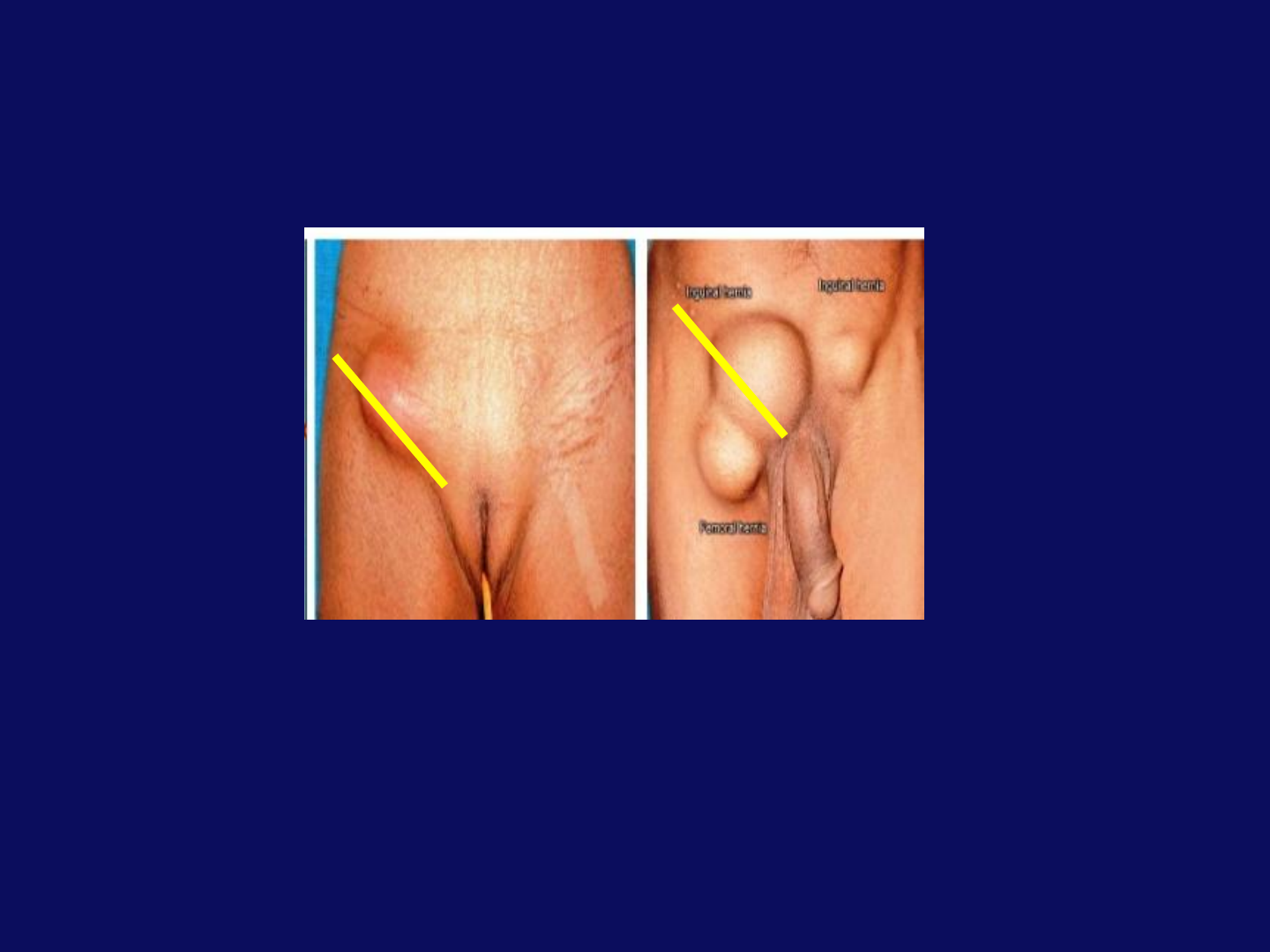 Hernia Clinic - Cirurgia Geral e Digestiva - Perguntas e respostas - HÉRNIA  INGUINAL Hérnias inguinais ou na virilha, ocorrem devido à fraqueza  muscular na parte inferior da parede abdominal, na área