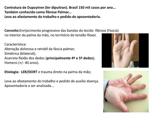 10 CONTRATURA DE DUPUYTREN