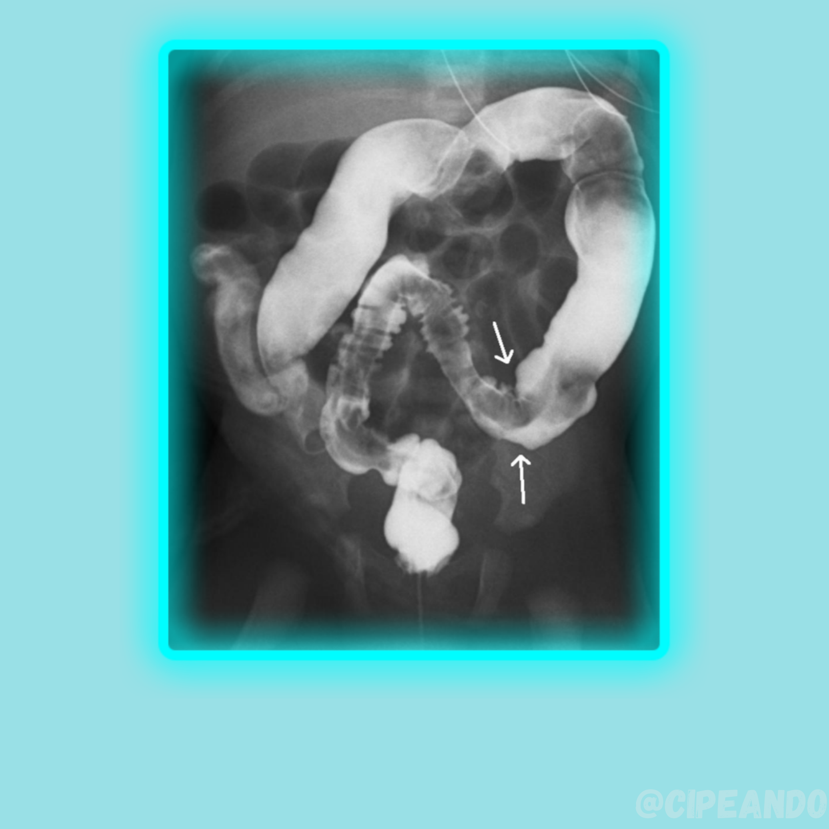 Grátis: Doença de Hirschsprung - Material Claro e Objetivo em PDF para  Estudo Rápido, image size:1620x1620