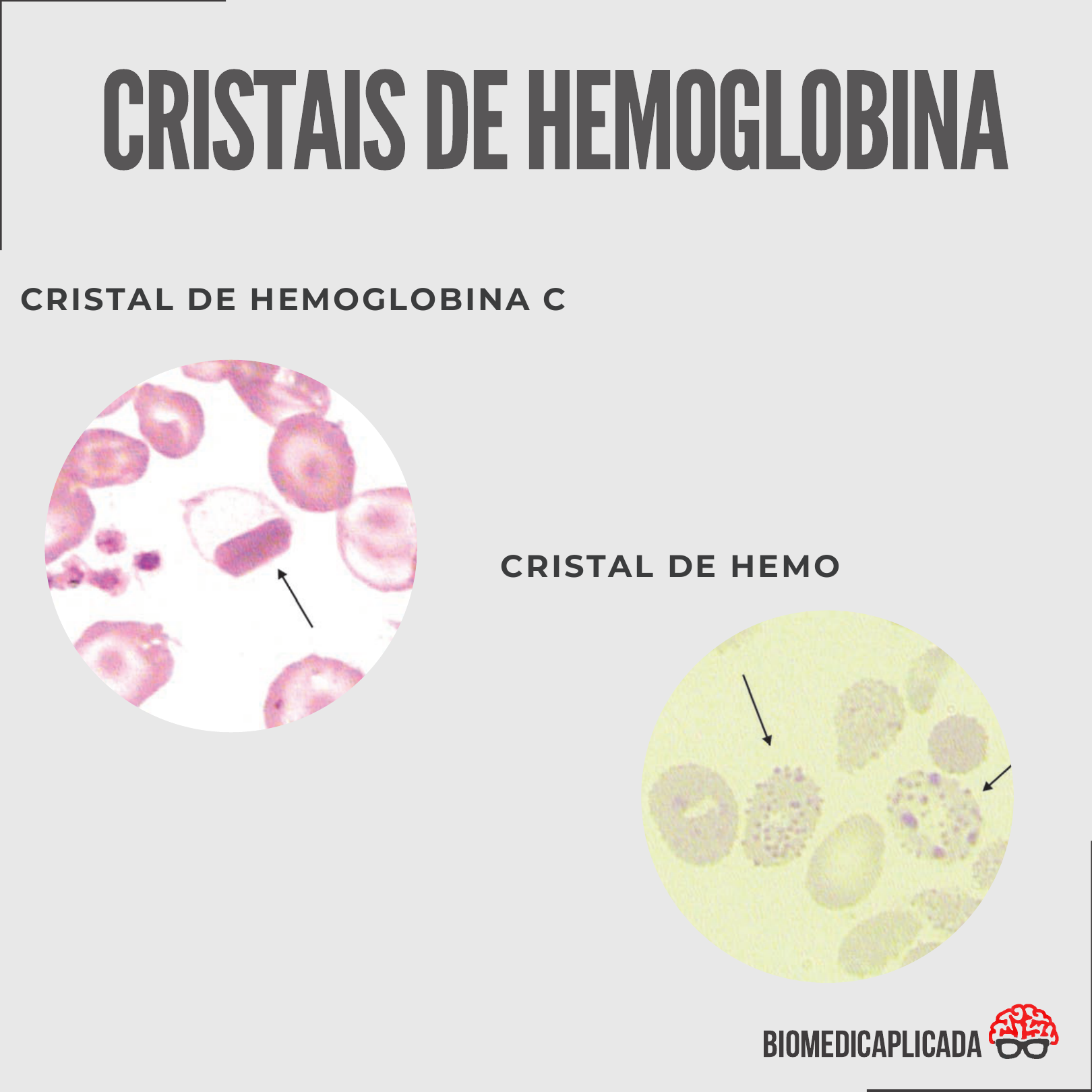 cristales de hemoglobina c