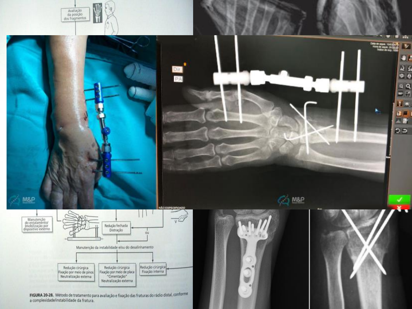 Tratamento minimamente invasivo para fratura toracolombar do tipo explosão  usando parafusos de alinhamento sagital e um dispositivo de redução de  trauma, image size:1440x1080