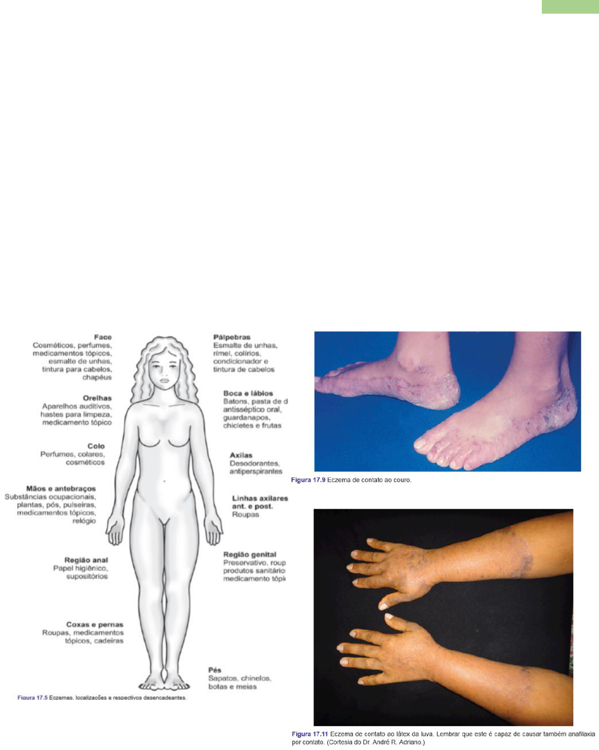 Grátis: DERMATOSES INFLAMATÓRIAS - Material Claro e Objetivo em PDF para  Estudo Rápido, image size:1183x1480