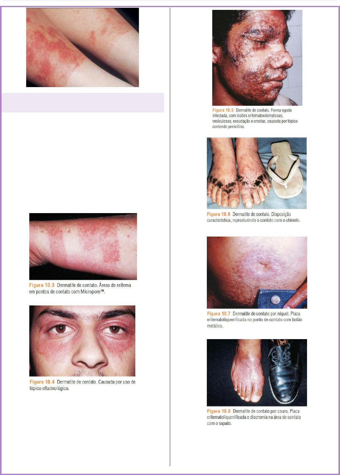Grátis: Síndromes Eczematosas - Material Claro e Objetivo em PDF para  Estudo Rápido, image size:1103x1538