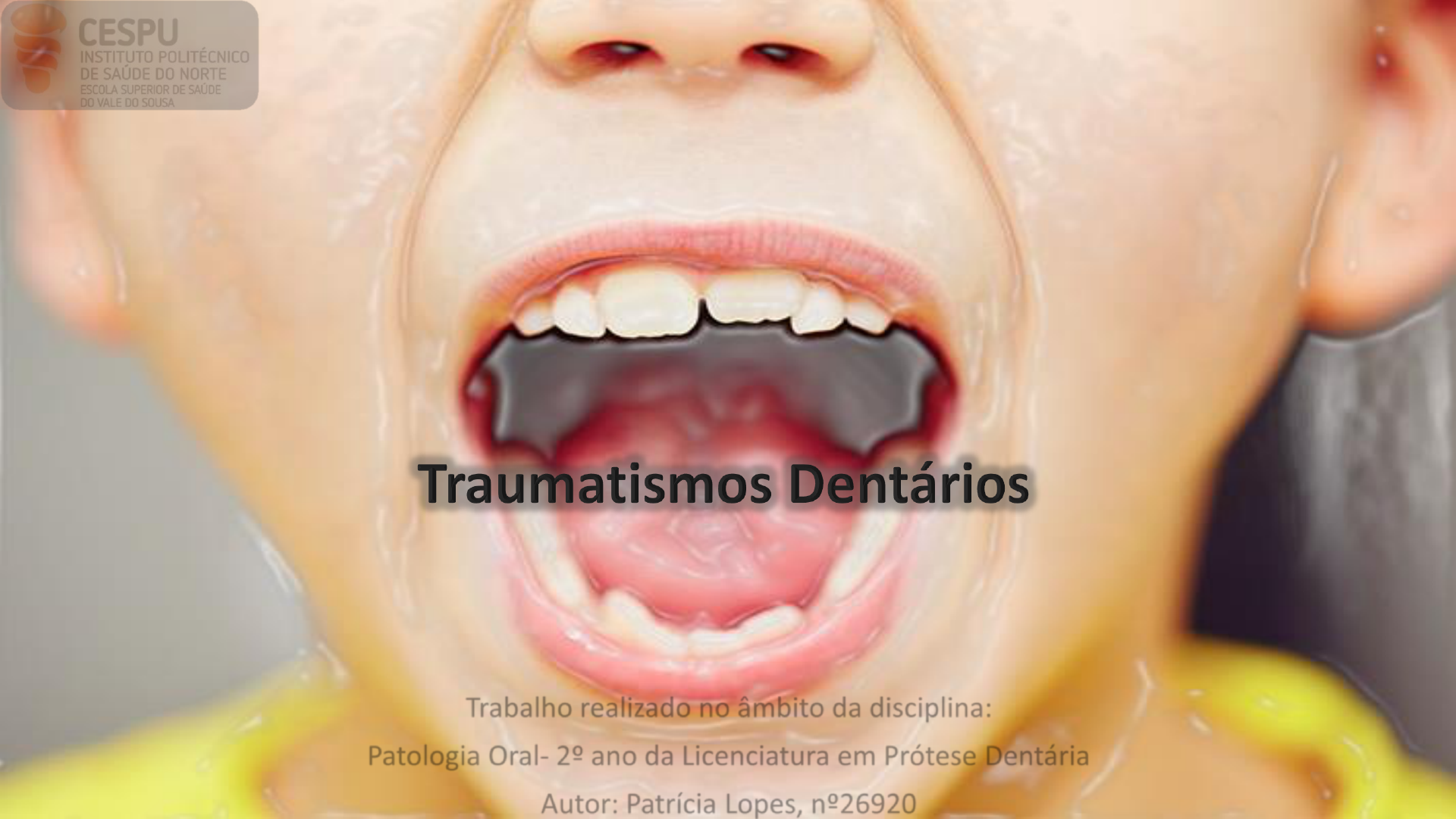 Traumatismo Dentário Apresentação - Patologia I