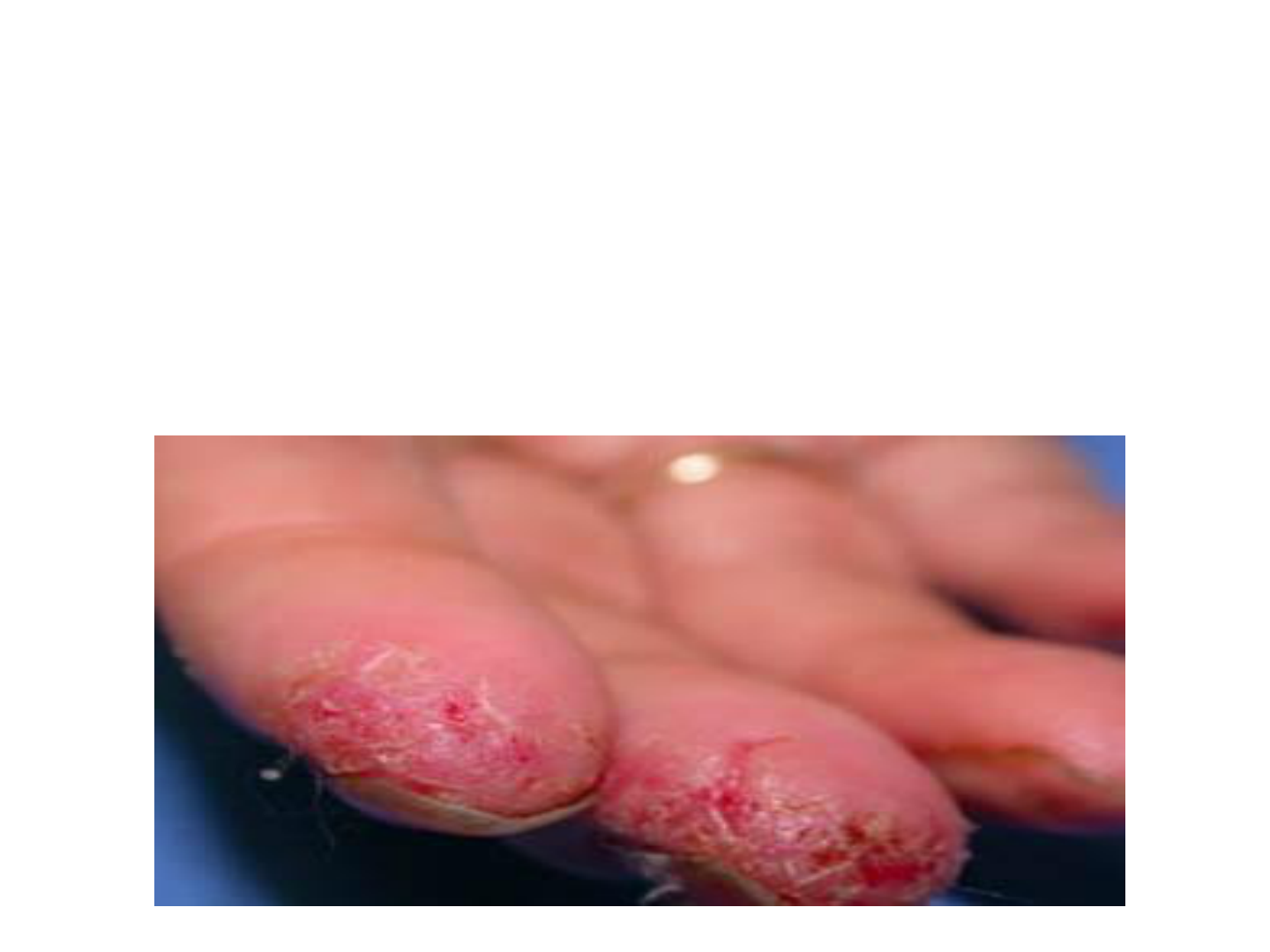 PPT - DERMATITE ATÓPICA PowerPoint Presentation, free download - ID:2316718, image size:1440x1080