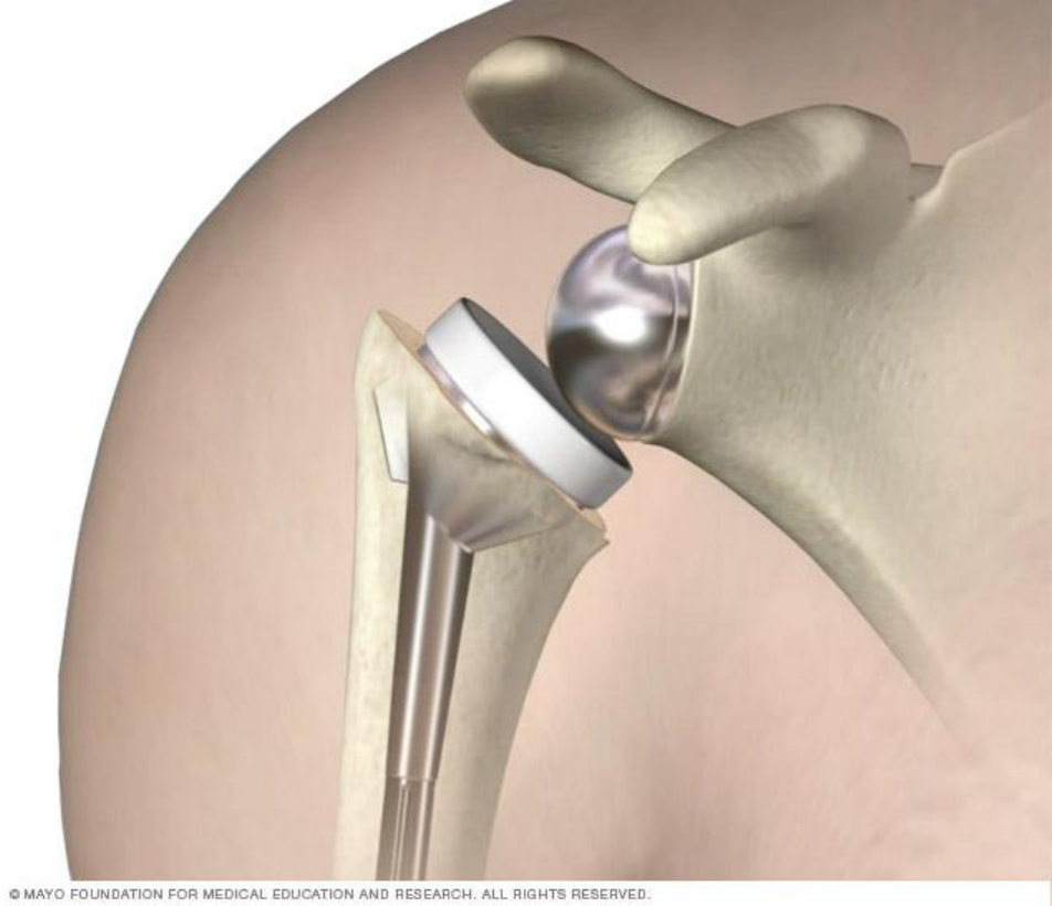 Arthroscopic rotator cuff repair - Mayo Clinic