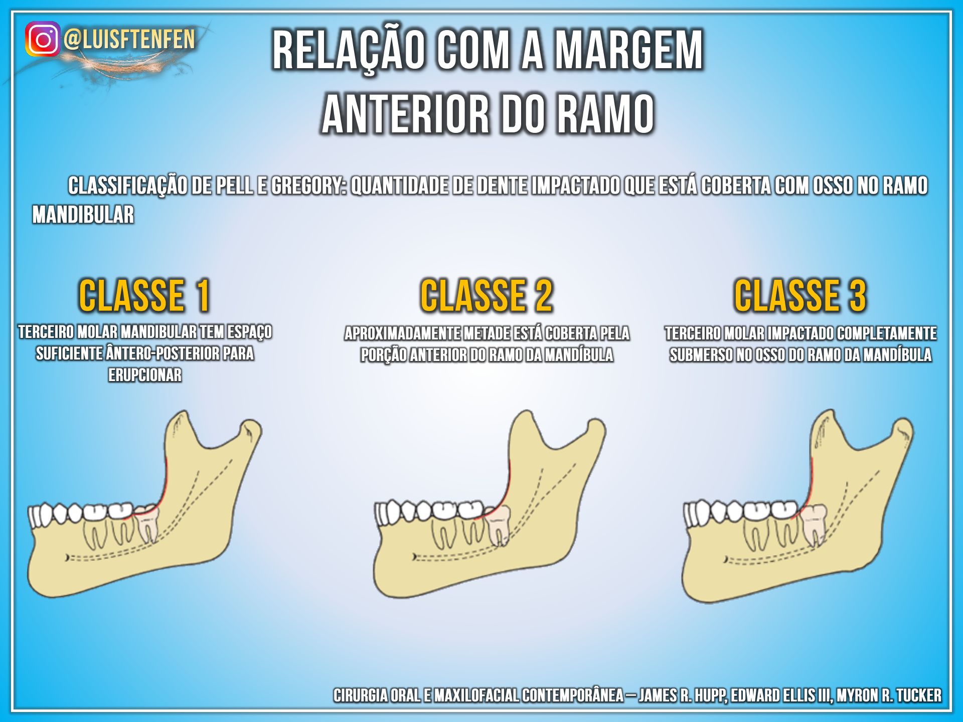 Classificação de Dentes Impactados Cirurgia