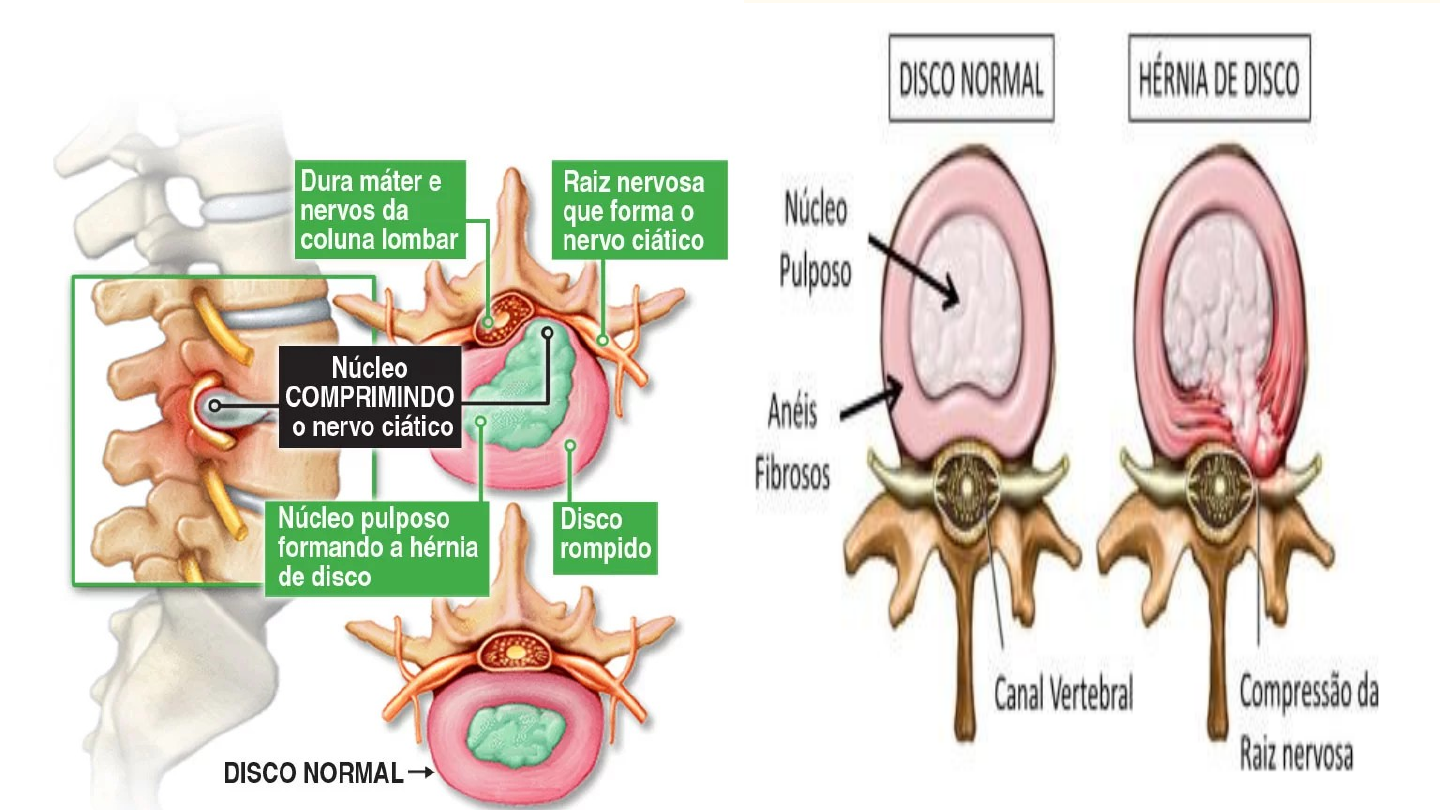 Hérnia de Disco - Fisioterapia