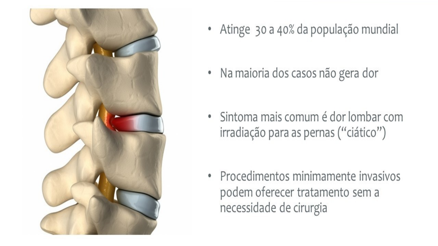 Hérnia de Disco - Fisioterapia