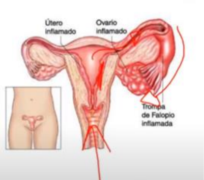 Dr. Carlos Roberto - Ginecologia - A DIPA (Doença Inflamatória Pélvica  Aguda) é uma infecção dos órgãos reprodutivos femininos (útero, trompas e  ovários). ▫ A DIPA ocorre quando bactérias patogênicas proliferam na