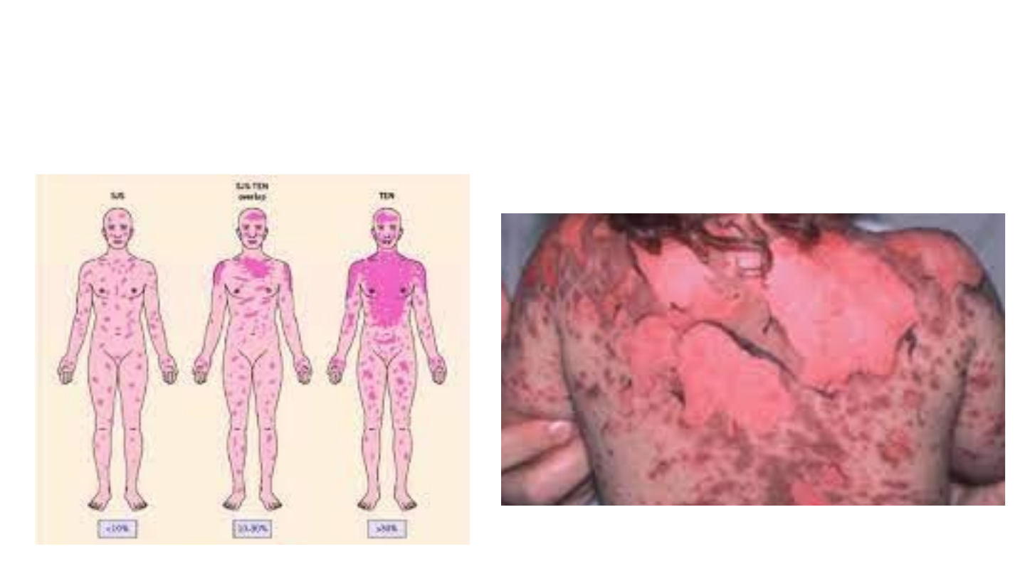 Síndrome de Stevens-Johnson, necrólise epidérmica tóxica e outros