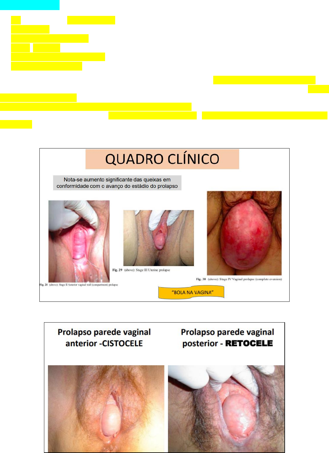 Prolapso genital - Ginecologia e Obstetrícia